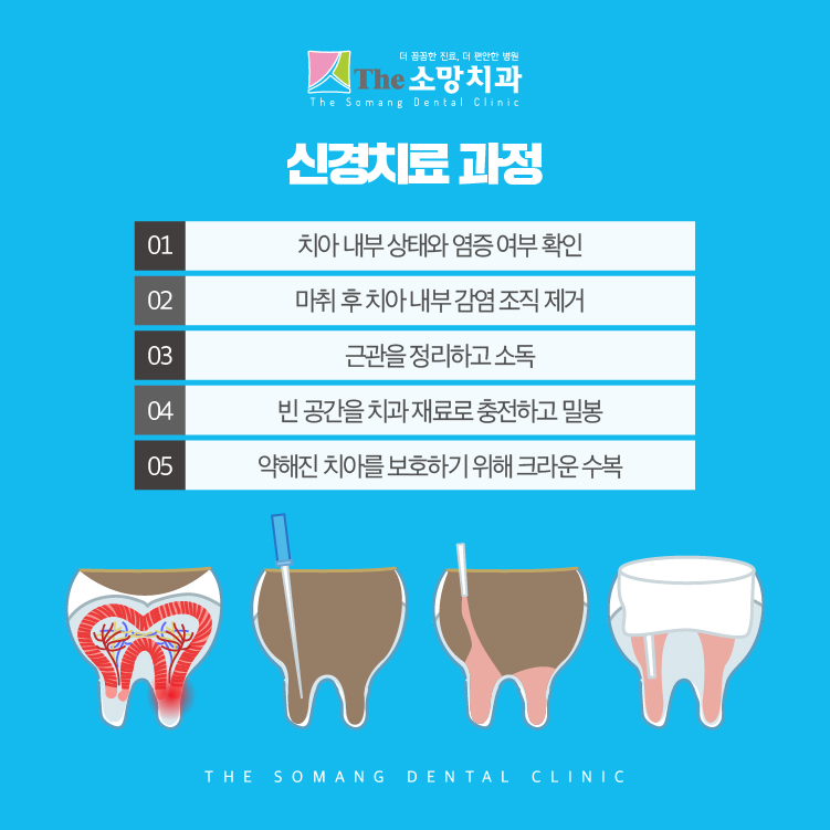 더소망치과-신경치료